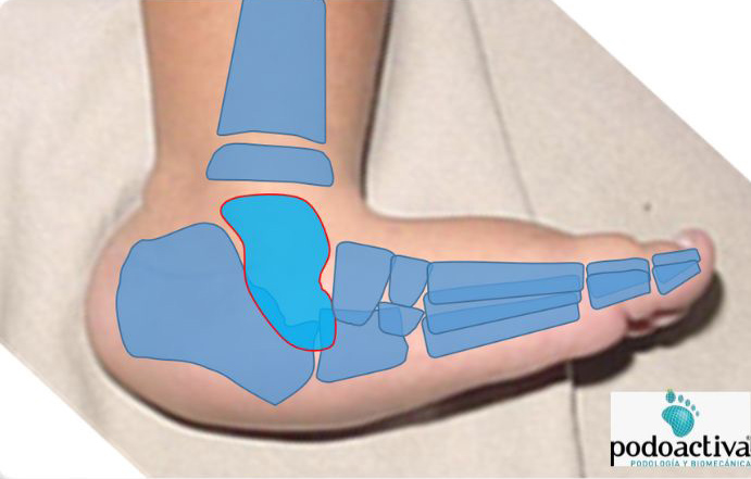 pie en balancín o astrágalo vertical congénito aislado (AVC)