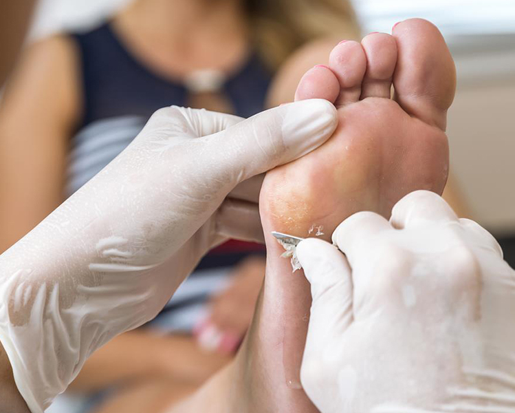 Rivera Foot and Ankle - Cómo Quitar un Callo en la Parte Inferior del Pie