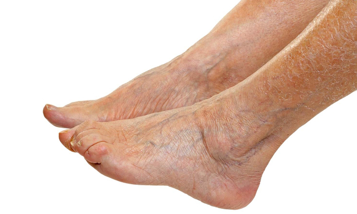 Ortopedia del Ángel - Una mala circulación en las piernas se manifiesta de  varias maneras: desde la hinchazón y la retención de líquidos en las piernas,  pies y tobillos, hasta los pies
