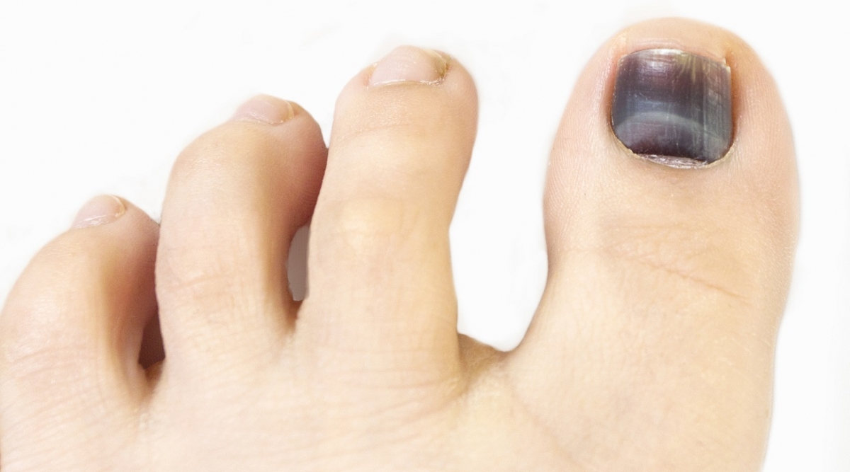 Aprender acerca 75+ imagen como curar uñas negras del pie
